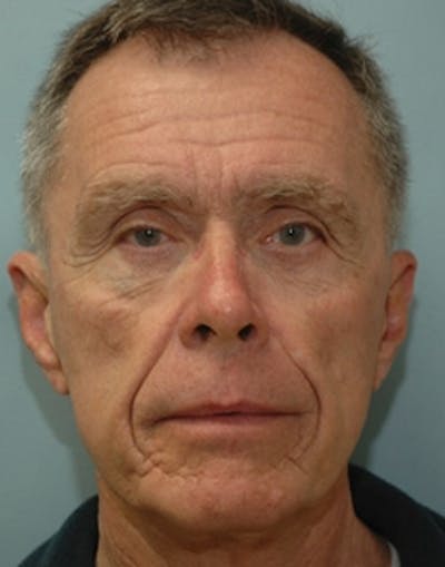 Mini Facelift Before & After Gallery - Patient 285414 - Image 1