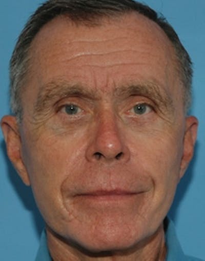 Mini Facelift Before & After Gallery - Patient 285414 - Image 2