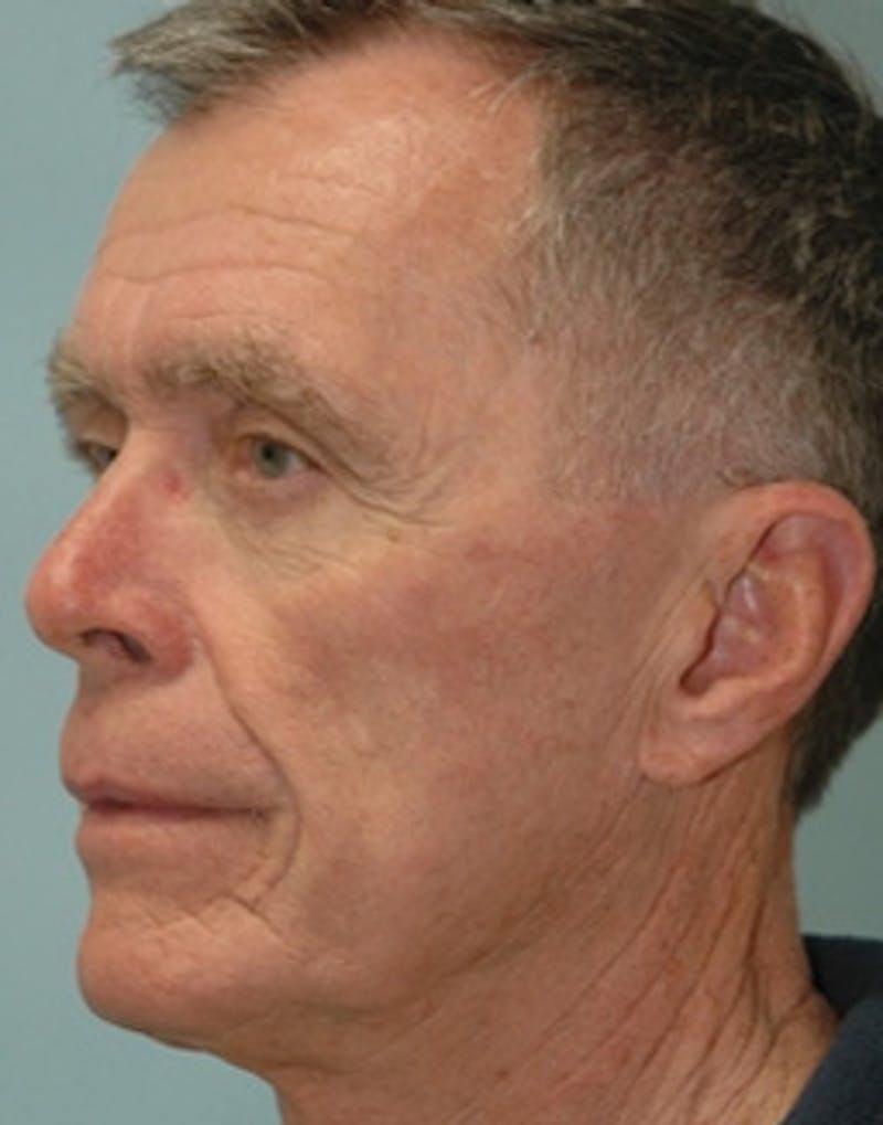 Mini Facelift Before & After Gallery - Patient 285414 - Image 3