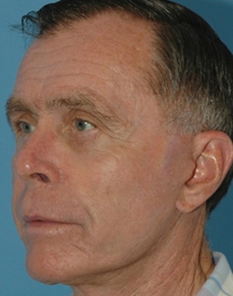 Mini Facelift Before & After Gallery - Patient 285414 - Image 4