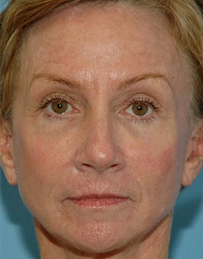Mini Facelift Before & After Gallery - Patient 322918 - Image 2