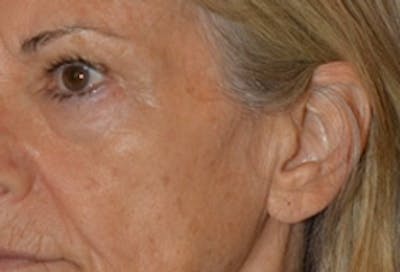 Facelift Incisions Before & After Gallery - Patient 360545 - Image 1