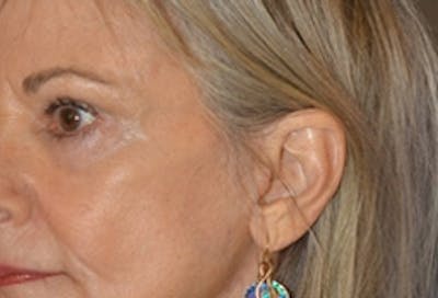 Facelift Incisions Before & After Gallery - Patient 360545 - Image 2