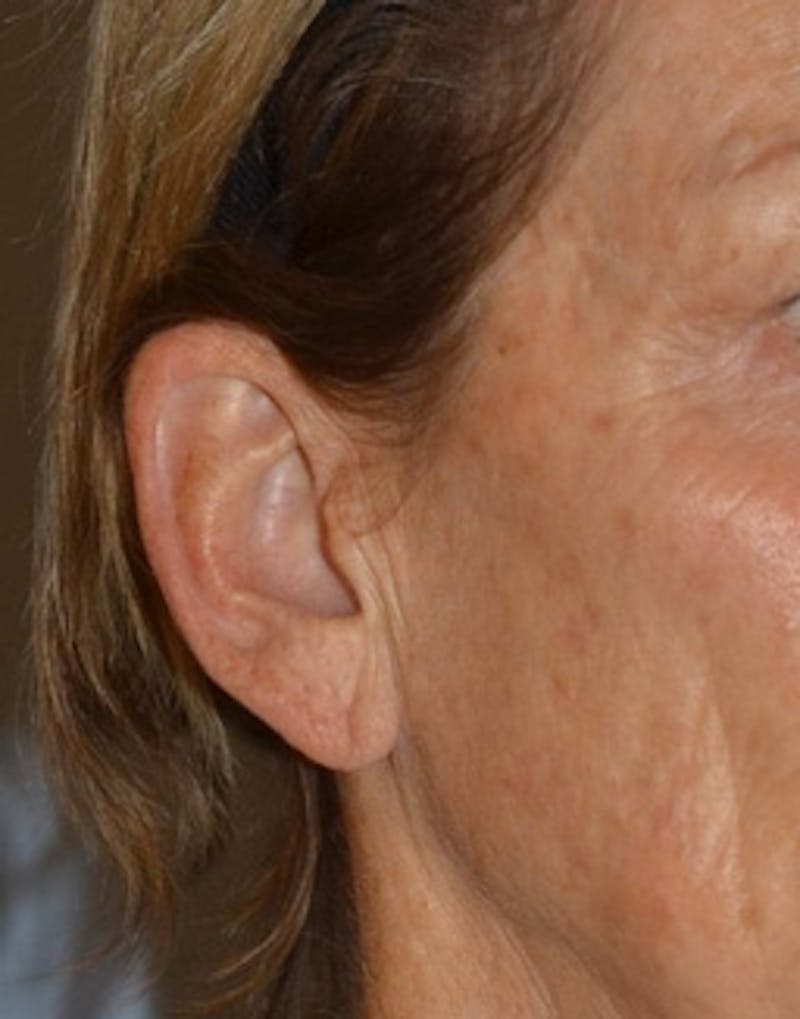 Facelift Incisions Before & After Gallery - Patient 360545 - Image 3