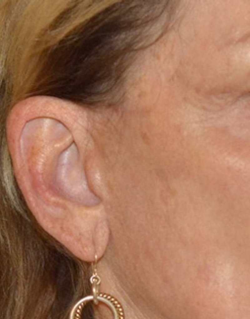 Facelift Incisions Before & After Gallery - Patient 360545 - Image 4