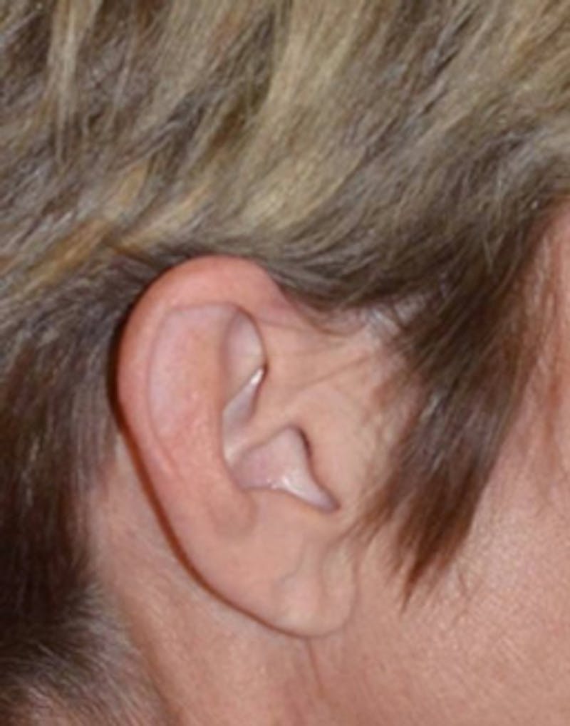 Facelift Incisions Before & After Gallery - Patient 360545 - Image 5