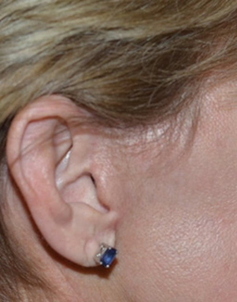 Facelift Incisions Before & After Gallery - Patient 360545 - Image 6