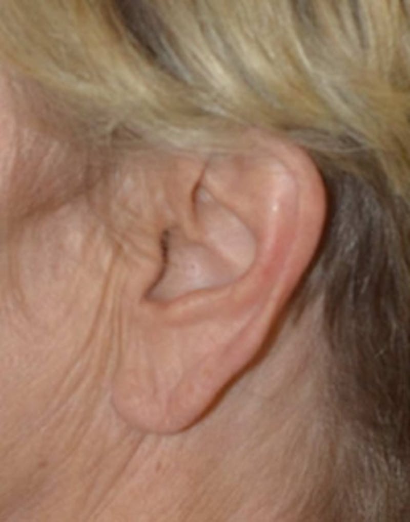Facelift Incisions Before & After Gallery - Patient 360545 - Image 7