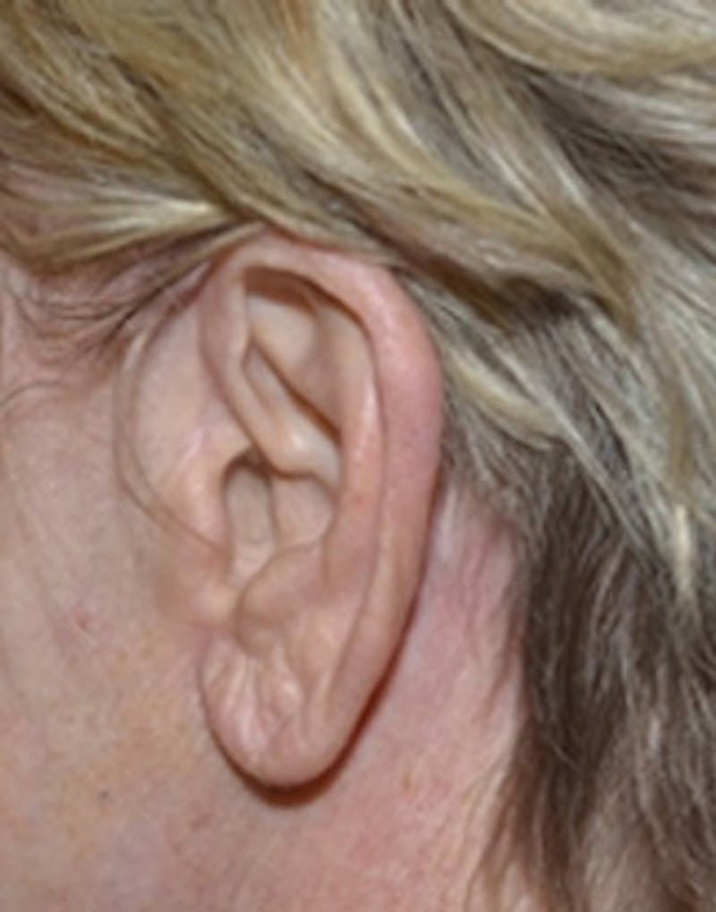 Facelift Incisions Before & After Gallery - Patient 360545 - Image 8