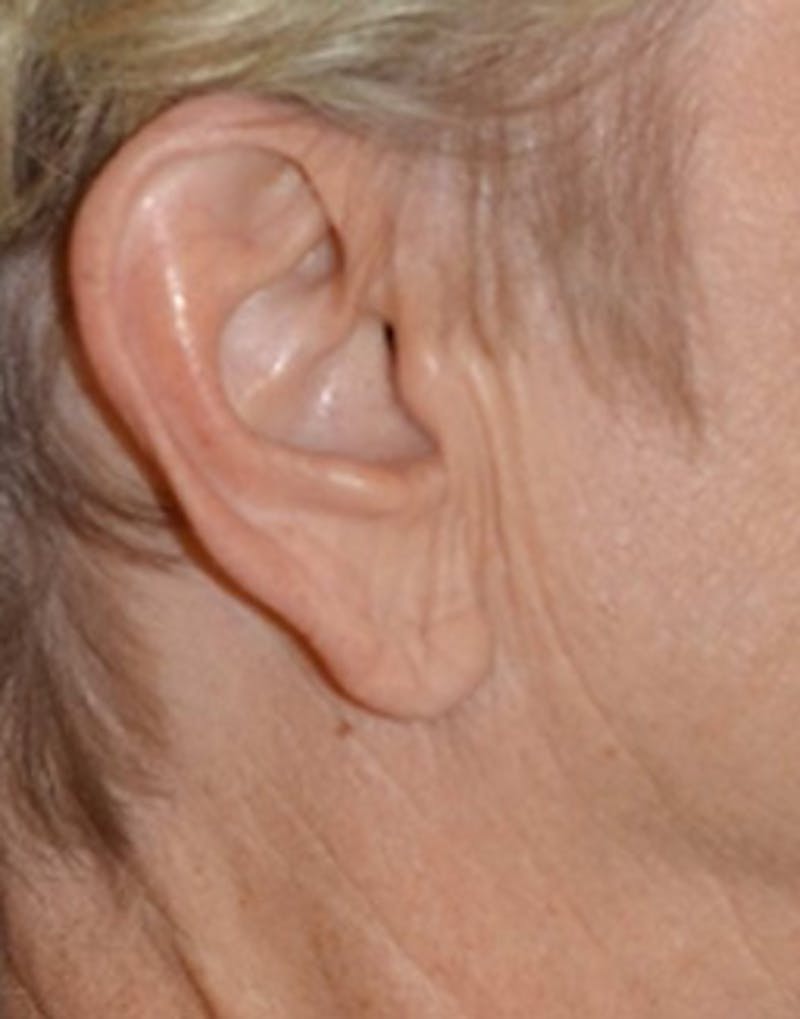 Facelift Incisions Before & After Gallery - Patient 360545 - Image 9