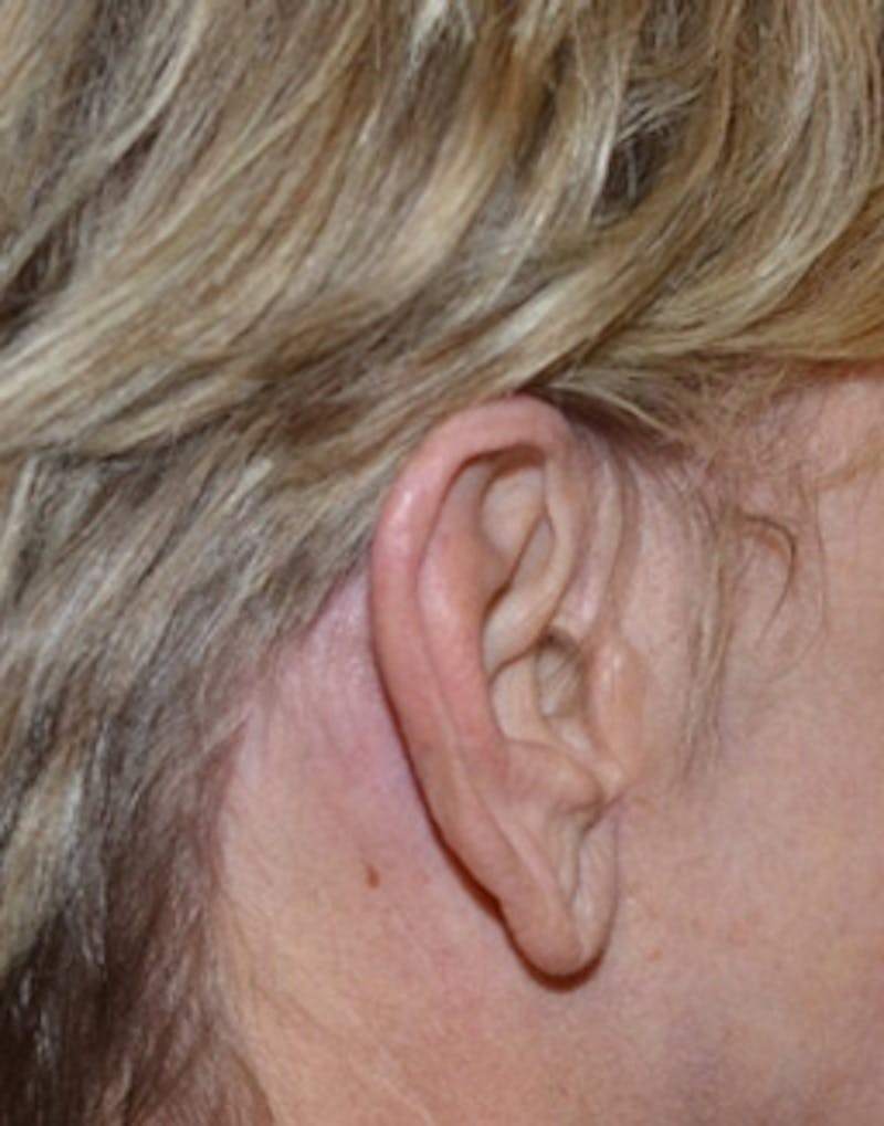 Facelift Incisions Before & After Gallery - Patient 360545 - Image 10
