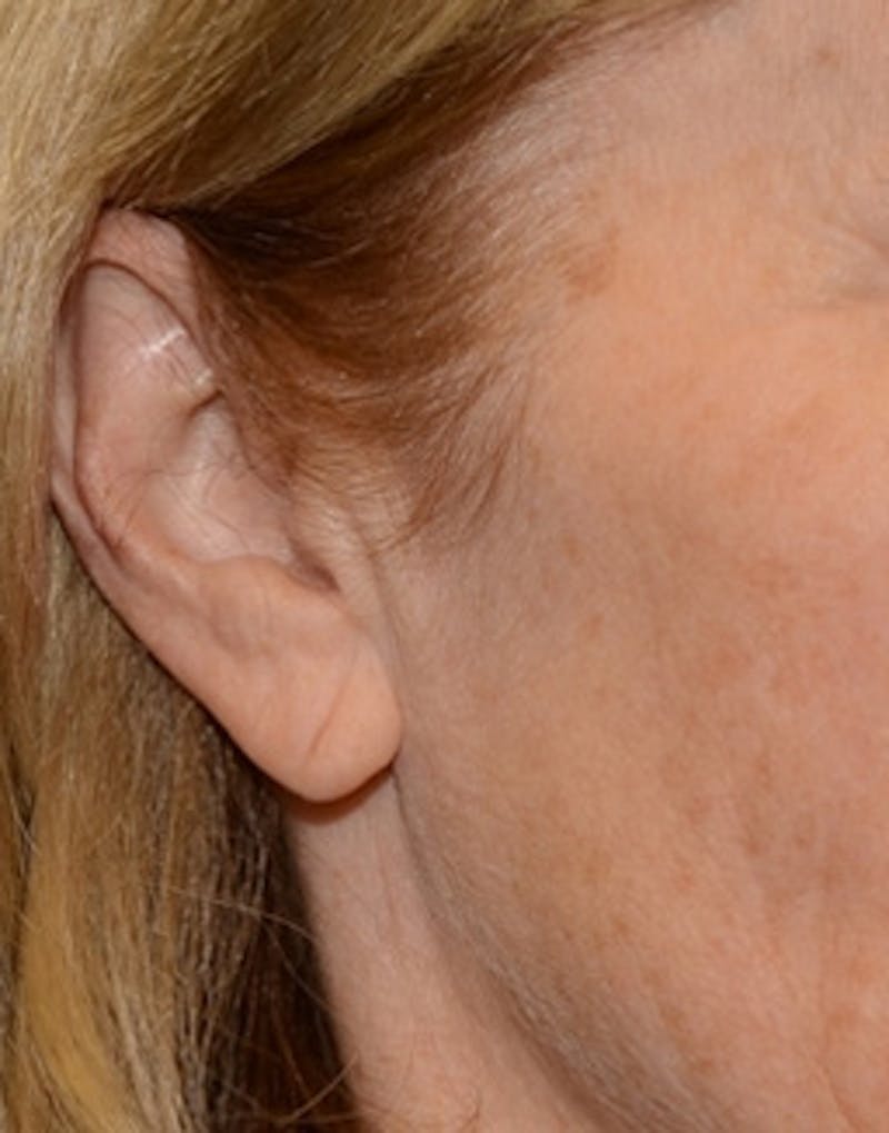 Facelift Incisions Before & After Gallery - Patient 360545 - Image 11