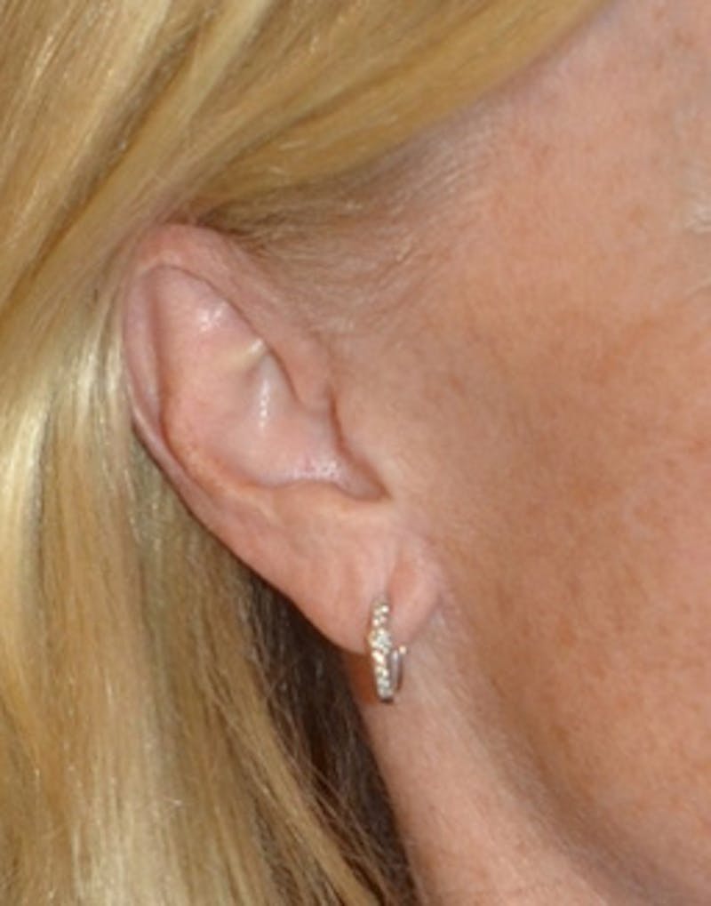 Facelift Incisions Before & After Gallery - Patient 360545 - Image 12