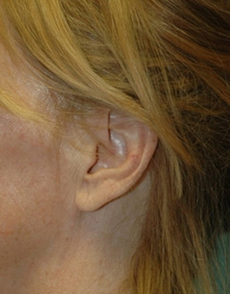 Facelift Incisions Before & After Gallery - Patient 360545 - Image 13