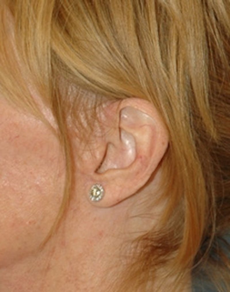 Facelift Incisions Before & After Gallery - Patient 360545 - Image 14