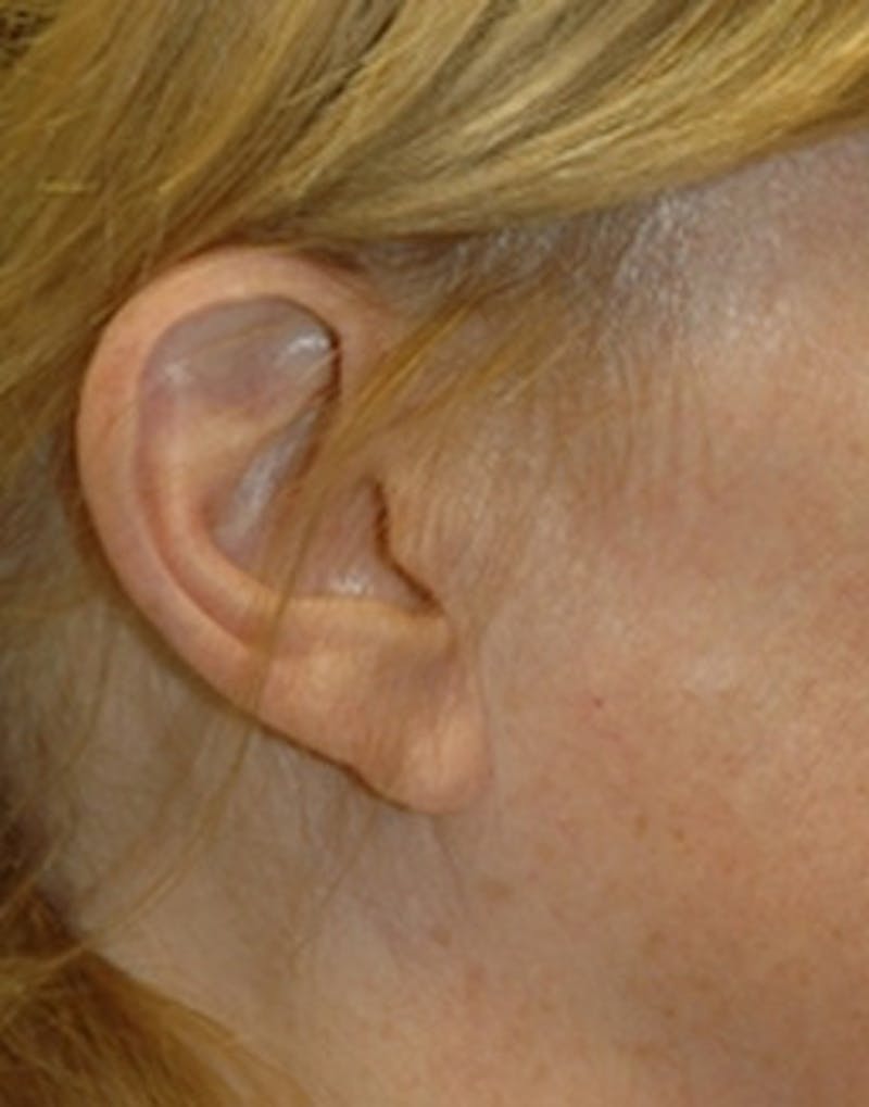 Facelift Incisions Before & After Gallery - Patient 360545 - Image 15