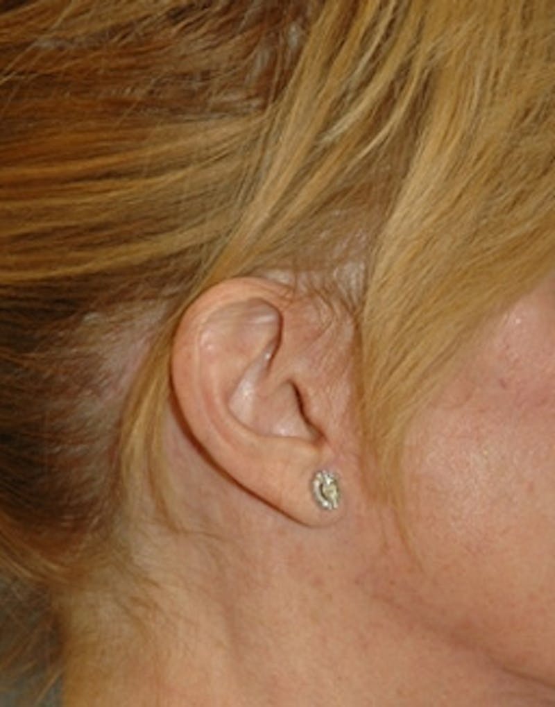 Facelift Incisions Before & After Gallery - Patient 360545 - Image 16