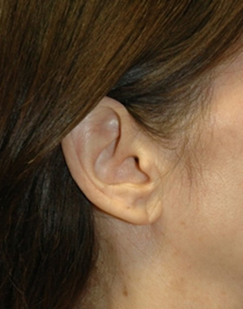 Facelift Incisions Before & After Gallery - Patient 360545 - Image 17