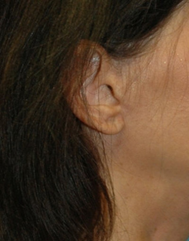 Facelift Incisions Before & After Gallery - Patient 360545 - Image 18