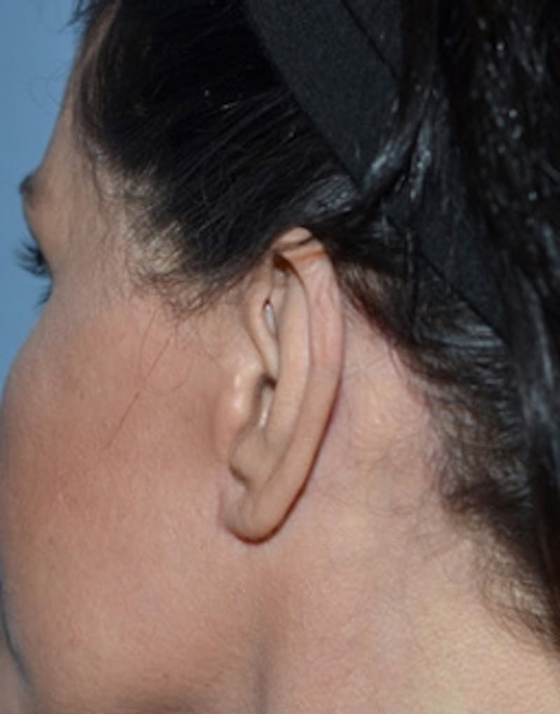 Facelift Incisions Before & After Gallery - Patient 360545 - Image 19