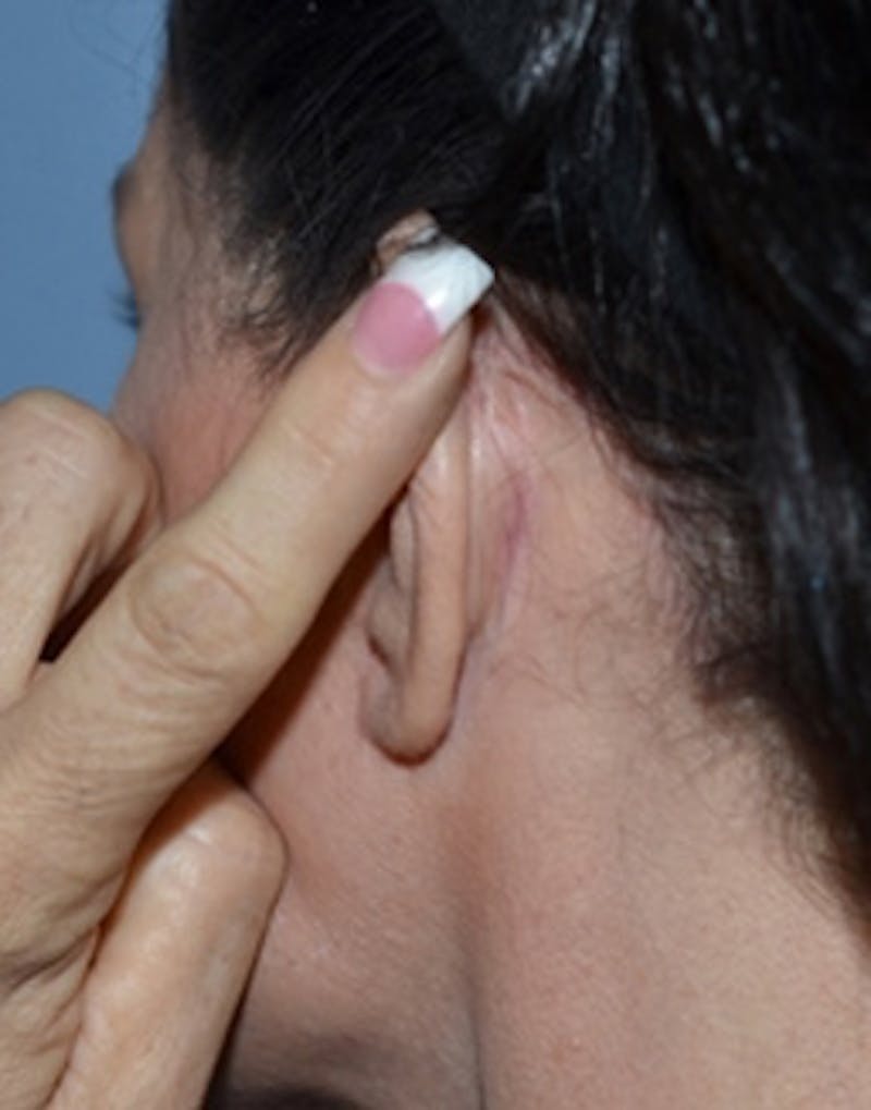 Facelift Incisions Before & After Gallery - Patient 360545 - Image 20