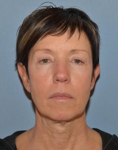 Facelift Incisions Before & After Gallery - Patient 105753 - Image 1