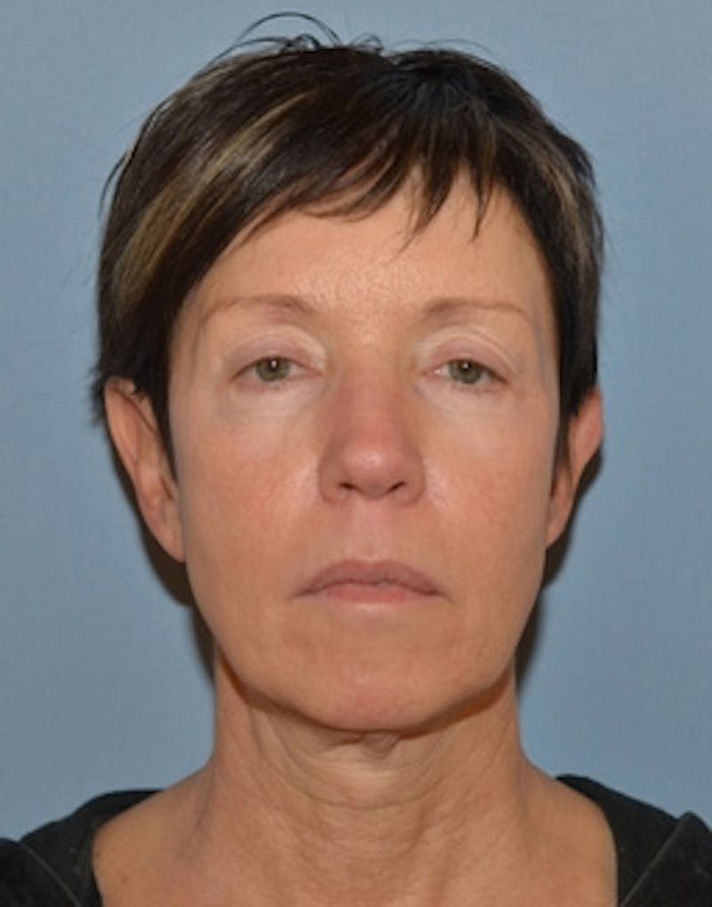 Facelift Incisions Before & After Gallery - Patient 105753 - Image 1
