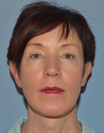 Facelift Incisions Before & After Gallery - Patient 105753 - Image 2