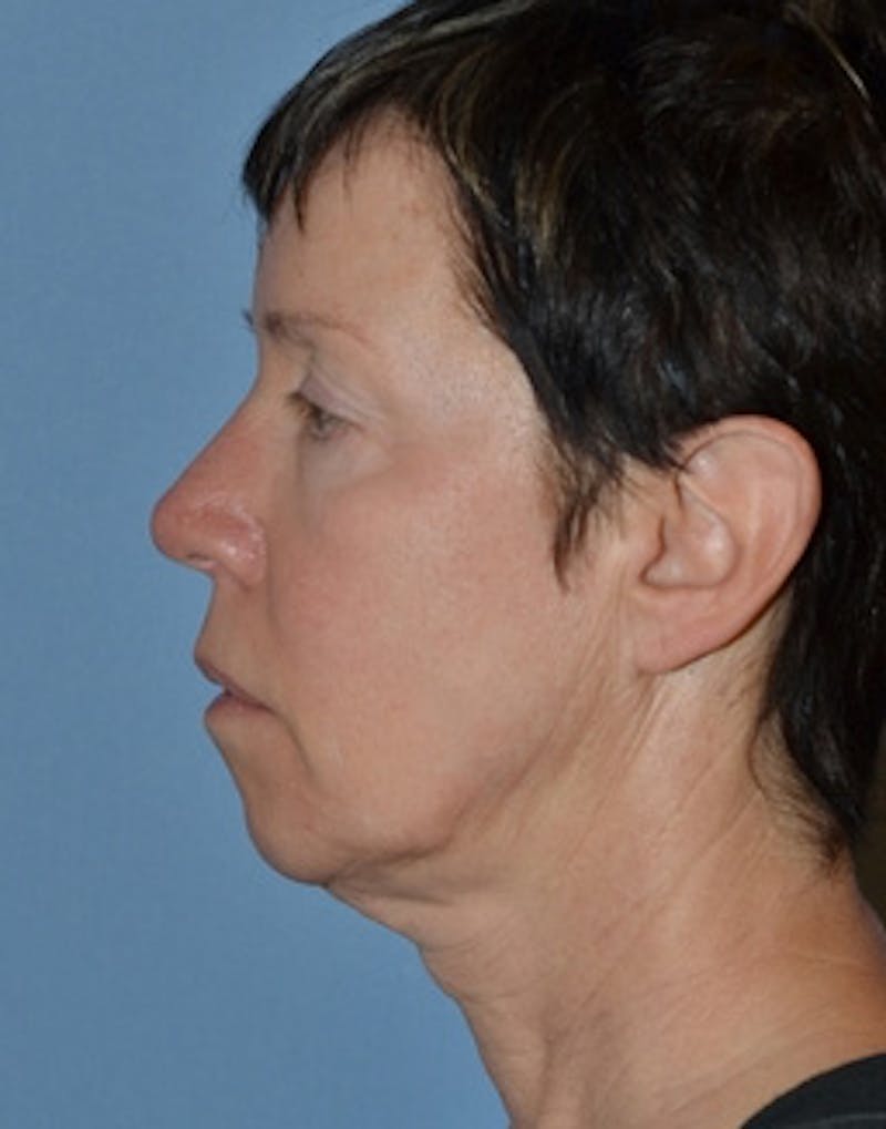 Facelift Incisions Before & After Gallery - Patient 105753 - Image 3