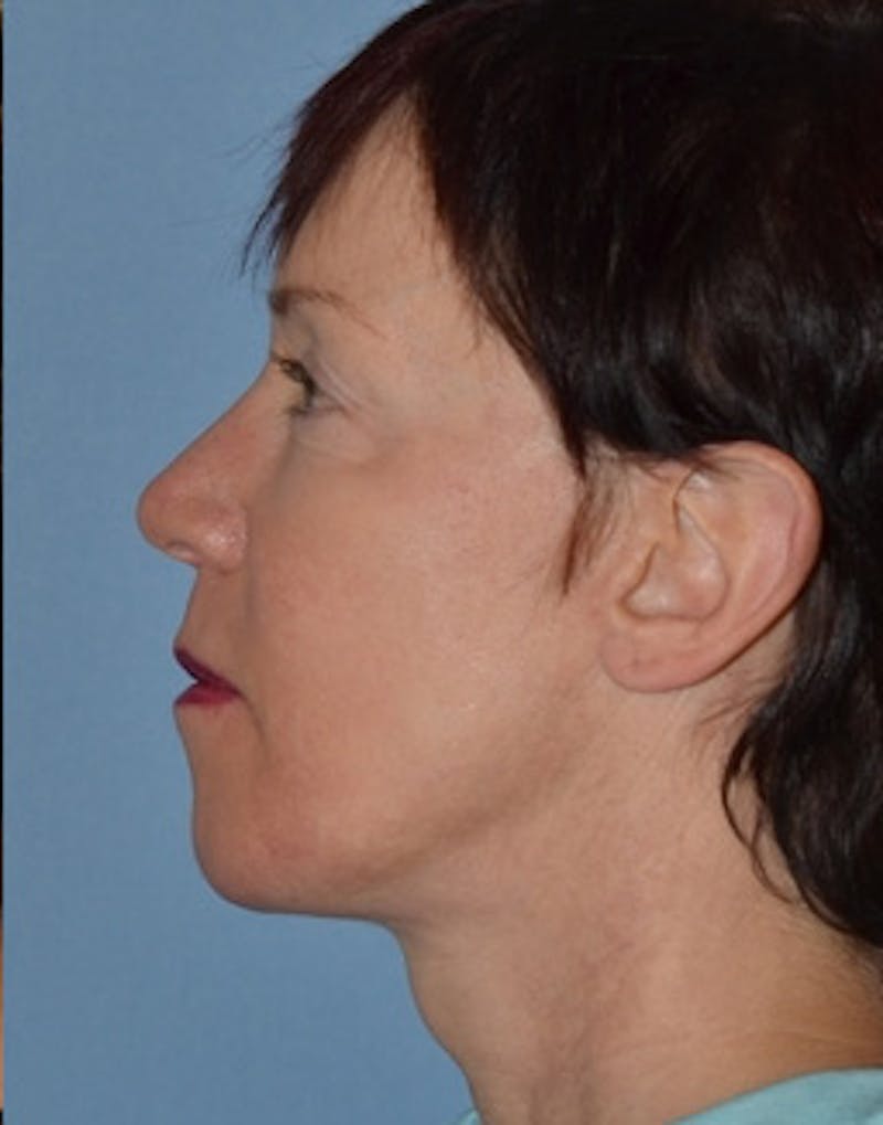 Facelift Incisions Before & After Gallery - Patient 105753 - Image 4