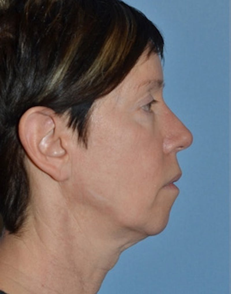 Facelift Incisions Before & After Gallery - Patient 105753 - Image 5