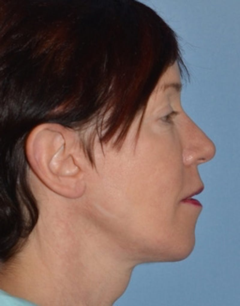 Facelift Incisions Before & After Gallery - Patient 105753 - Image 6