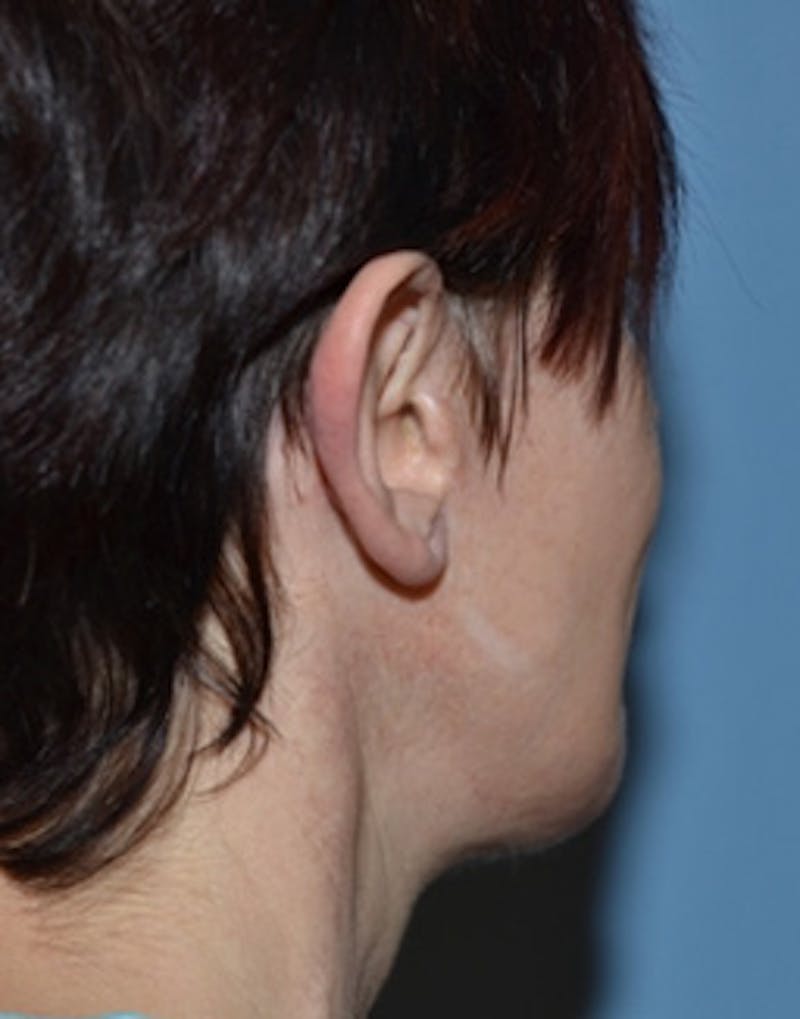 Facelift Incisions Before & After Gallery - Patient 105753 - Image 7