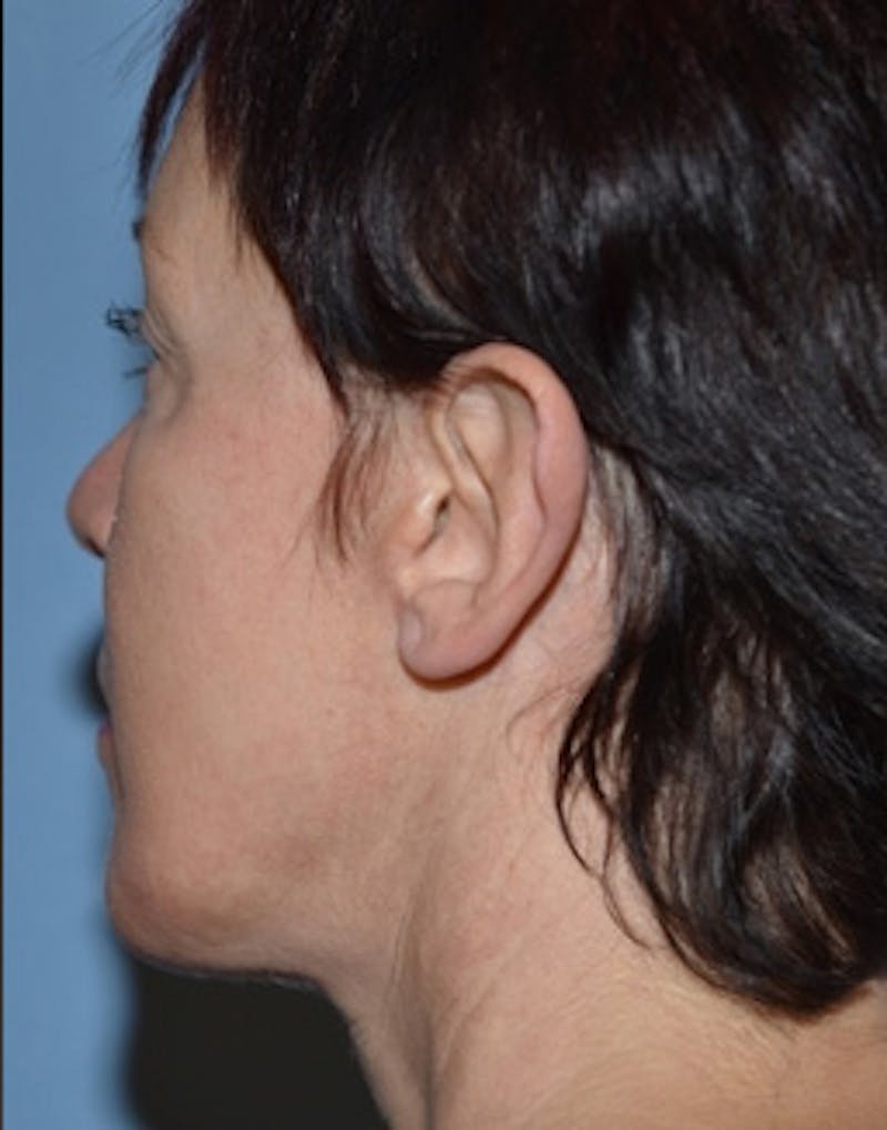 Facelift Incisions Before & After Gallery - Patient 105753 - Image 8