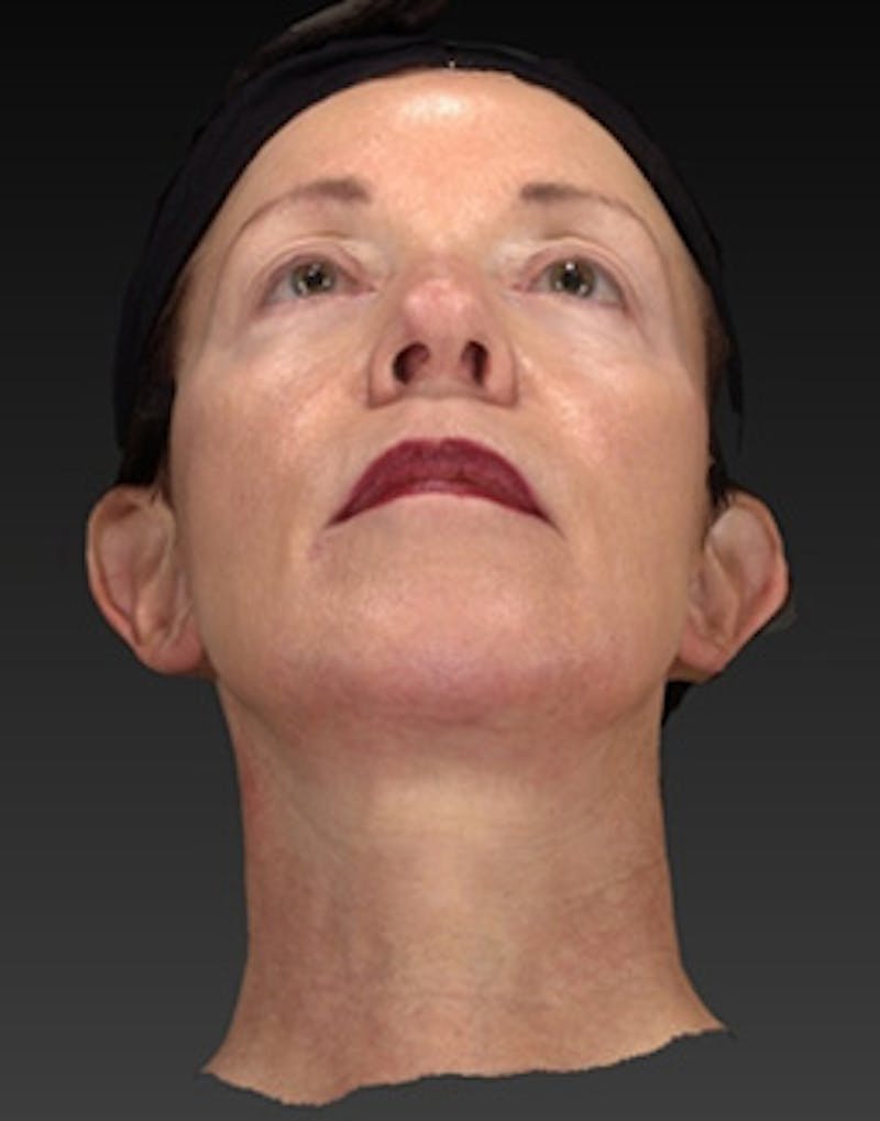 Facelift Incisions Before & After Gallery - Patient 105753 - Image 10