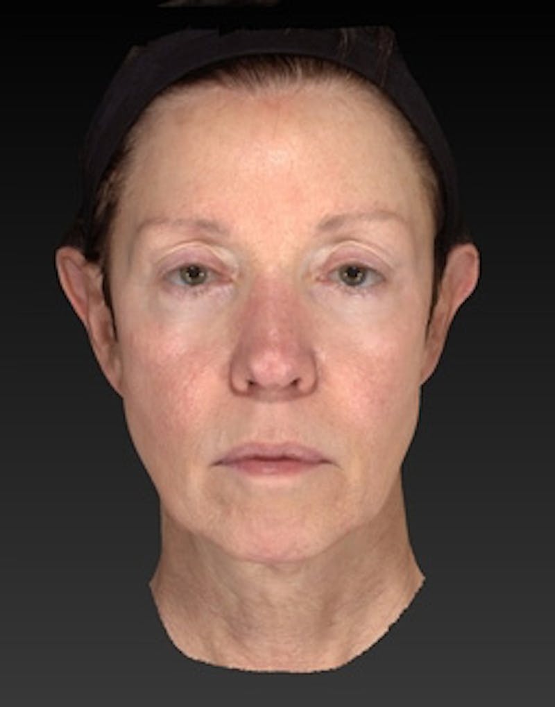 Facelift Incisions Before & After Gallery - Patient 105753 - Image 11