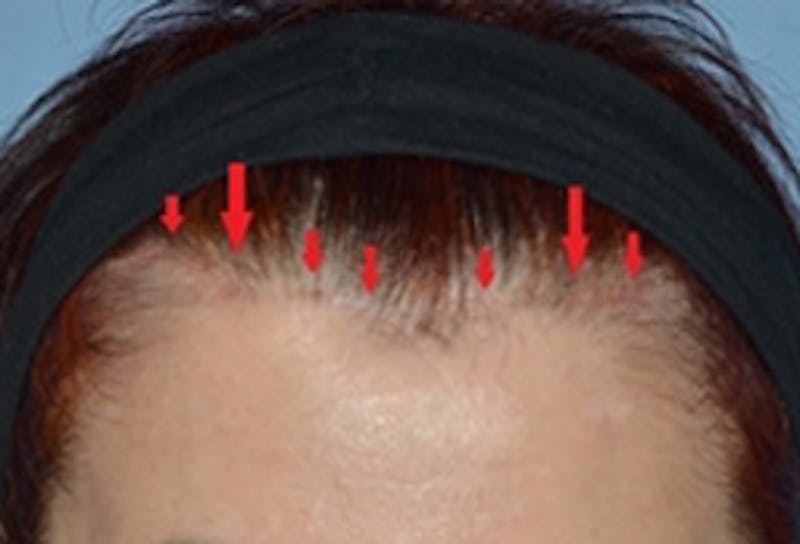 Facelift Incisions Before & After Gallery - Patient 133997 - Image 1