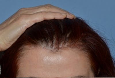 Facelift Incisions Before & After Gallery - Patient 133997 - Image 2