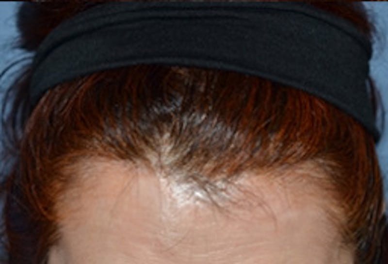 Facelift Incisions Before & After Gallery - Patient 133997 - Image 3