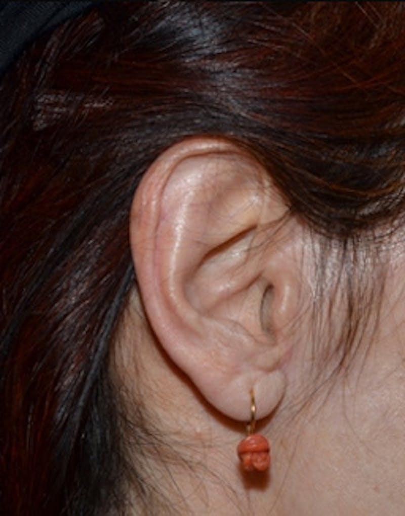 Facelift Incisions Before & After Gallery - Patient 133997 - Image 6