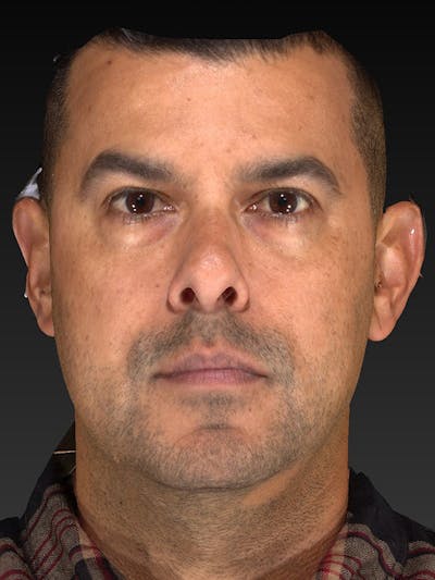 Blepharoplasty Before & After Gallery - Patient 337944 - Image 1