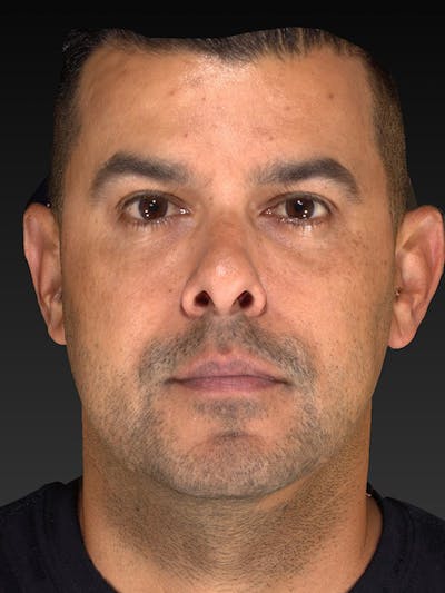 Blepharoplasty Before & After Gallery - Patient 337944 - Image 2
