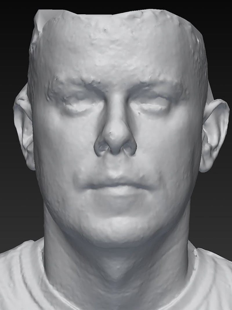 Blepharoplasty Before & After Gallery - Patient 337944 - Image 4