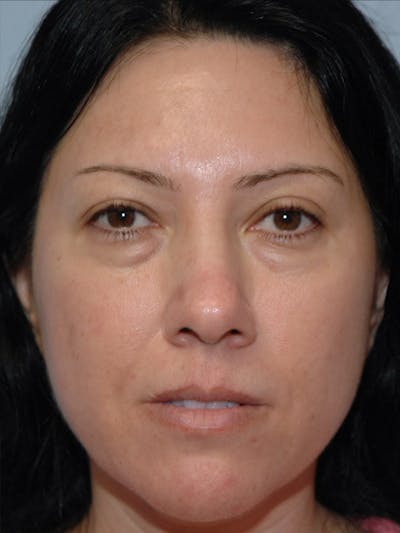 Blepharoplasty Before & After Gallery - Patient 914254 - Image 1