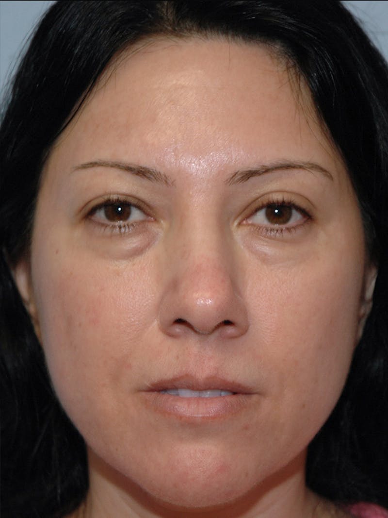 Blepharoplasty Before & After Gallery - Patient 914254 - Image 1