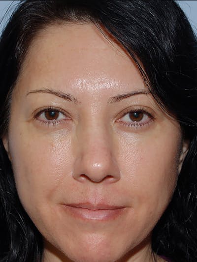 Blepharoplasty Before & After Gallery - Patient 914254 - Image 2