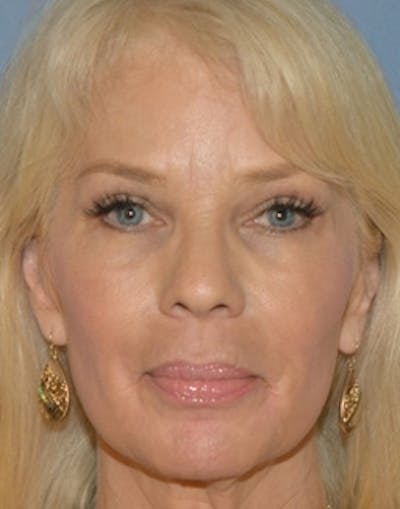Blepharoplasty Before & After Gallery - Patient 164287 - Image 2