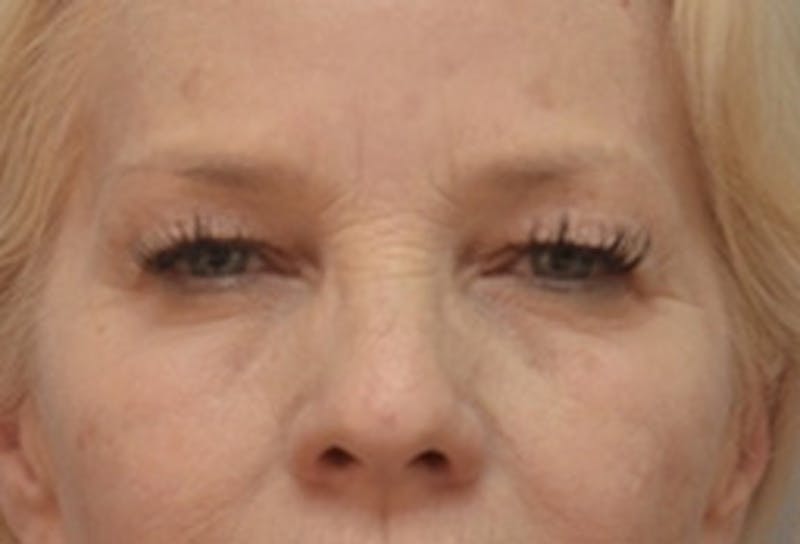 Blepharoplasty Before & After Gallery - Patient 164287 - Image 3