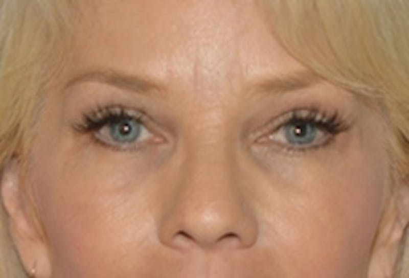 Blepharoplasty Before & After Gallery - Patient 164287 - Image 4