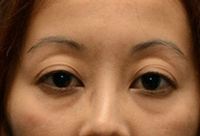 Blepharoplasty Before & After Gallery - Patient 768011 - Image 1